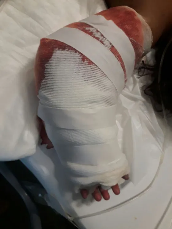 Tartagal: Lograron re implantarle el brazo a la bebita que se accidentó con un seca ropas