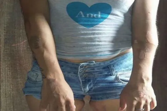 La azotó, la golpeó y la quemó con una cuchara caliente por celos