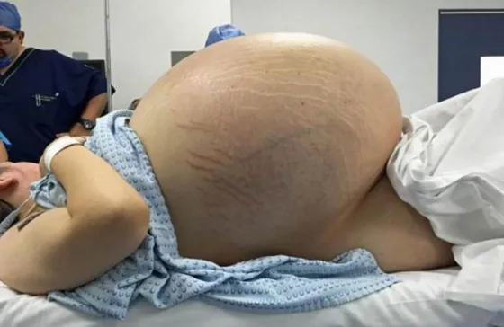 Pensaron que tendría trillizos : una ecografía echó luz sobre la cruel realidad