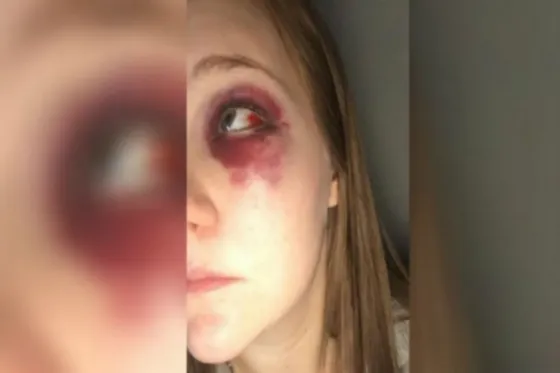 Por defender a su amiga, ella también terminó golpeada