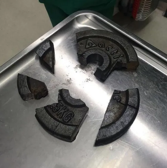 Atoró su miembro en una pesa del gimnasio