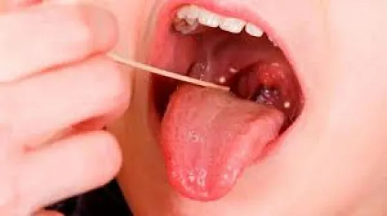 Seis personas murieron a causa de la bacteria estreptococo
