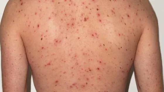 Alerta epidemiológica por un caso de sarampión