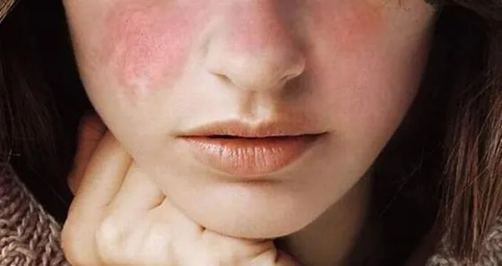 Crece el número de personas diagnosticadas con lupus en el norte de la provincia