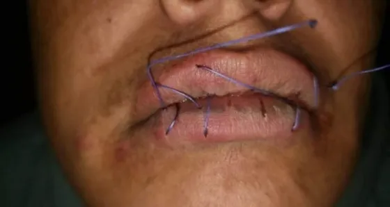 Un obrero municipal de Jujuy inició una huelga de hambre y se cosió la boca