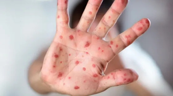 Alerta epidemiológica por un caso de rubeola en Buenos Aires