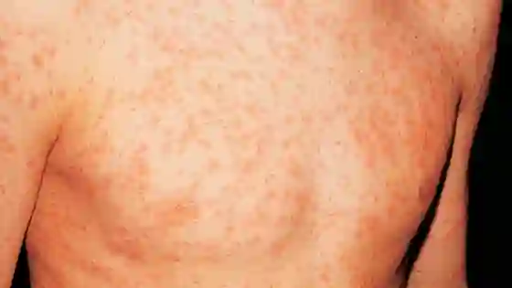 Recuerdan que se encuentran disponibles las vacunas contra la rubeola