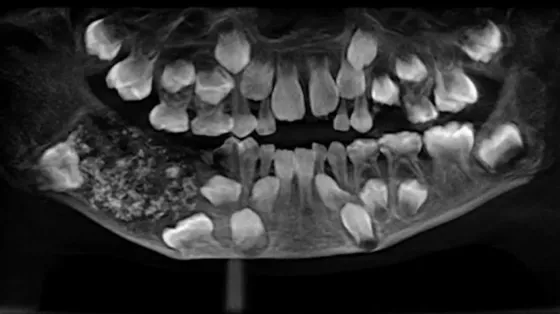 Niño de 7 años fue al dentista y le extrajeron 562 dientes