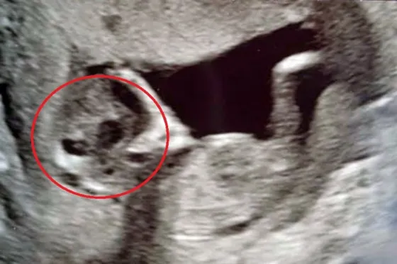 De terror: Se hizo una ecografía y vio la cara de un extraterrestre