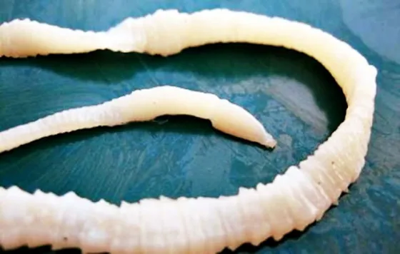 Fue la médico por un dolor de cabeza y se encontraron con una lombriz solitaria