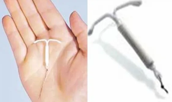 Increíble, un bebe nació con el DIU en la mano