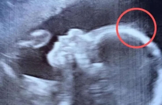 Algo extraño apareció en la cabeza de su bebé durante el ultrasonido . Mirá