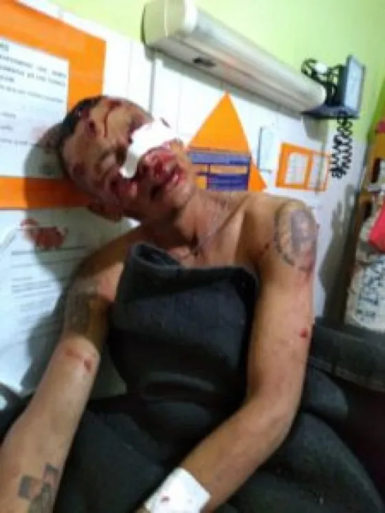 Investigan accionar policial contra un hombre herido con balas de goma en Ballivián