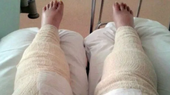 Una mujer casi pierde las piernas por hacerse el cavado