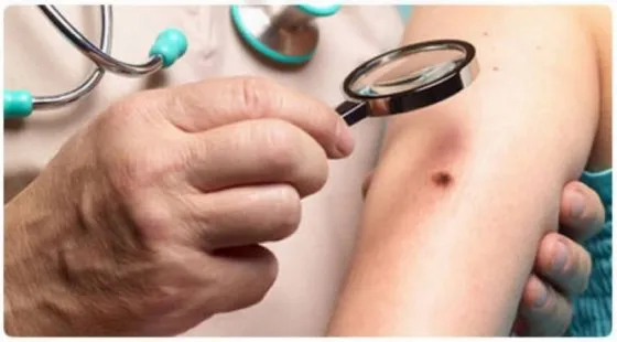 Cáncer de piel: el hospital Materno Infantil dictará una charla sobre prevención