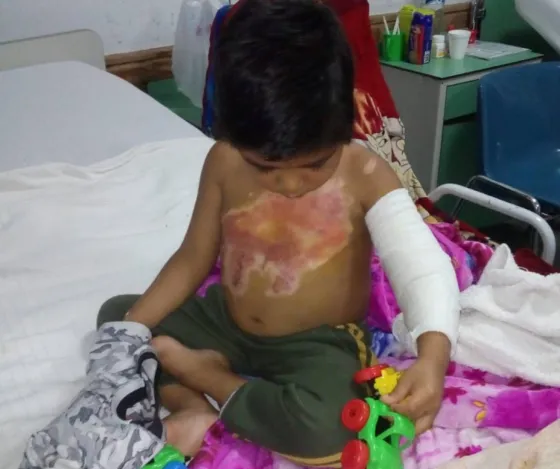Un niño de 4 años se quemó casi la mitad de su cuerpo y necesita tu ayuda