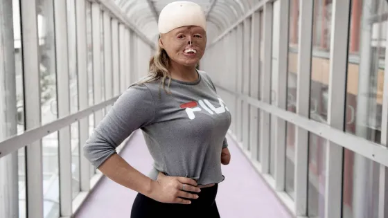 Joven salteña se quemó el 88% de su cuerpo y hoy es deportista y modelo