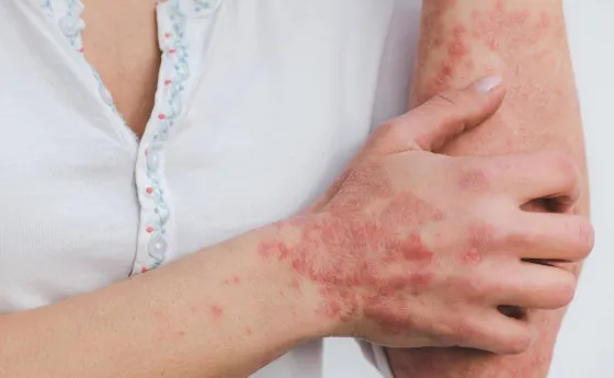 Preocupante: Detectaron personas con sarna en Tartagal