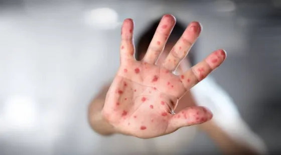 Argentina detectó el primer caso sospechoso de viruela del mono