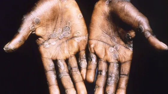 España detectó 59 casos de viruela del mono y tendrá que comprar vacunas