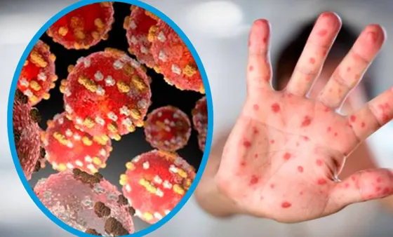 Aumentaron a 32 los casos de viruela del mono en la Argentina