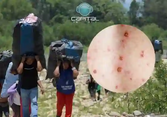 Viruela del Mono en la frontera de Salta: "Nos debe preocupar"