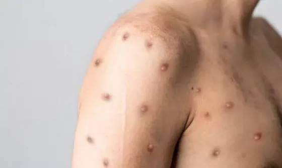 Confirmaron el primer caso de viruela del mono en Jujuy