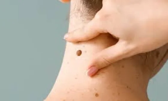 Se realizará una nueva edición de la campaña “Salvá tu piel”