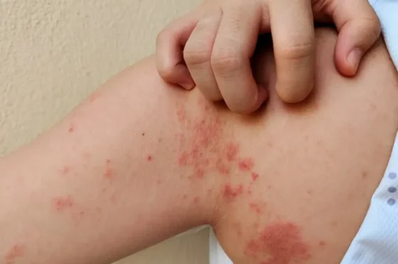 Se confirmó un caso de lepra en el departamento San Martín