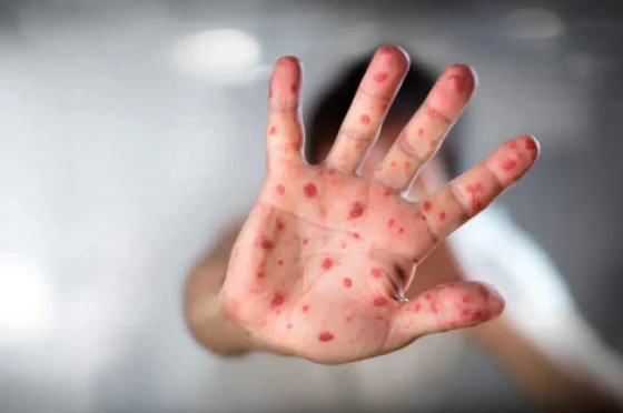 Sube a 74 el número de casos de sarampión en Bolivia, donde se mantiene la emergencia sanitaria