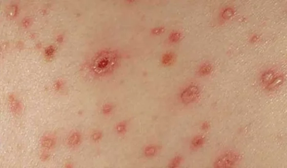 Durante el primer semestre, se notificaron más de 300 casos de varicela