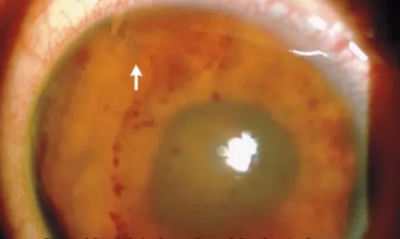 Le extirparon un gusano del ojo. Video