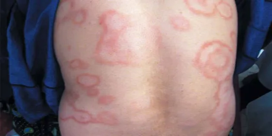 Lepra: Salud recuerda la importancia del diagnóstico