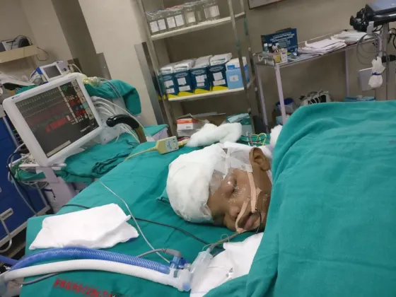 Separaron a dos siameses unidos por la cabeza