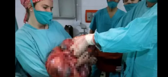 Impresionante cirugía en el país: Le sacaron un tumor de 20 kilos. Video