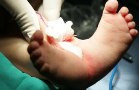 Nació otro  "bebé sirena" . Fotos