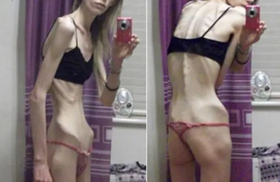 Estuvo al borde de la muerte por anorexia, pero mirala ahora