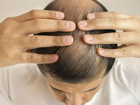 Caída del cabello, el nuevo síntoma luego de padecer la variante Ómicron