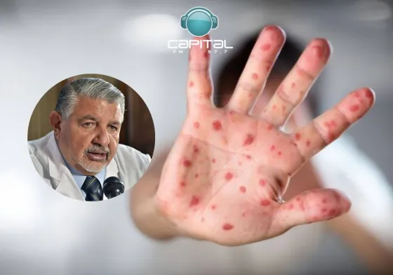 "Tenemos que estar atentos con la viruela del mono en Salta"