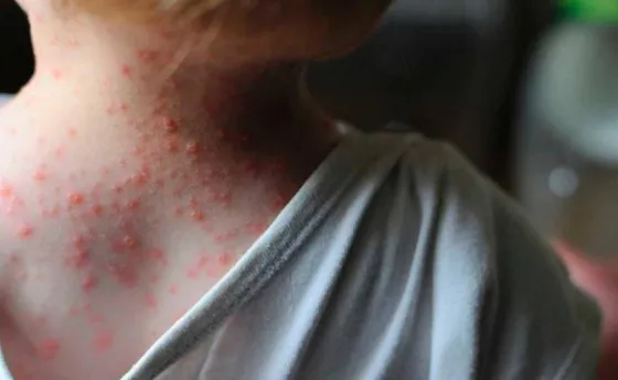 Confirmaron el sexto caso de viruela del mono en Argentina