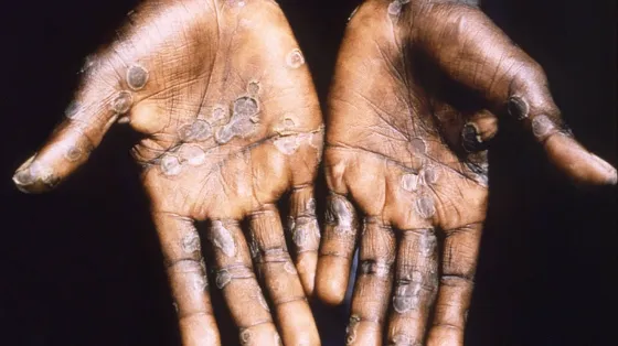 Según un estudio, el 95% de los casos de viruela del mono se transmite por actividad sexual