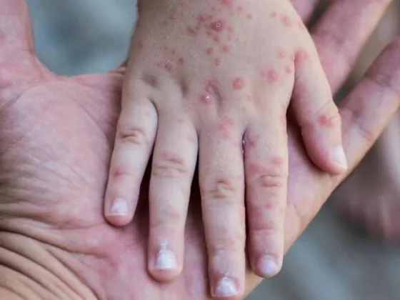 Viruela del mono: ascienden a 18 los casos en Argentina