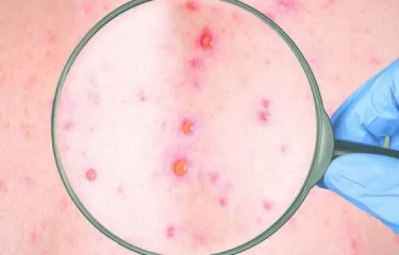 Viruela del mono: Confirmaron 170 casos en Argentina