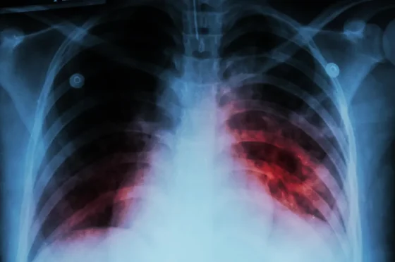 En 2024 se diagnosticaron 967 nuevos casos de tuberculosis en Salta