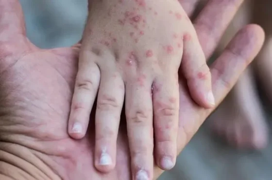 “¡Vacuná a tu hijo, ya!”: el ruego del Ministro de Salud por el brote de sarampión